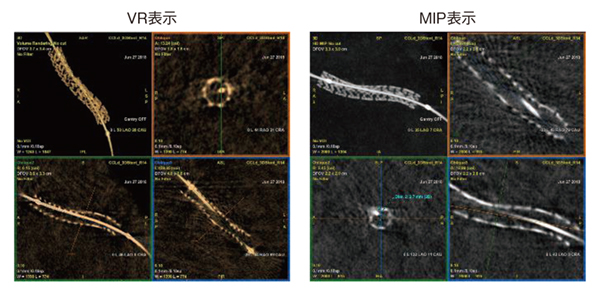 図3 3DStentの表示 図3 3DStentの表示