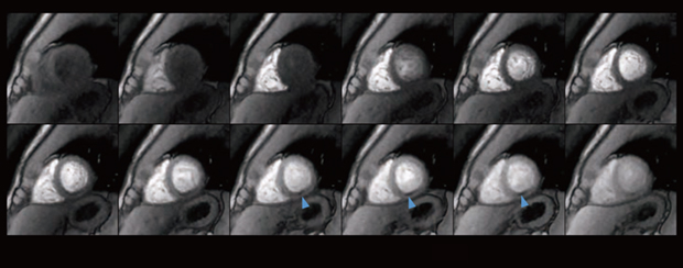 図2 AIR Recon DL+MoCoによる心筋パーフュージョン ▲:micro vascular obstruction 図2 AIR Recon DL+MoCoによる心筋パーフュージョン ▲:micro vascular obstruction