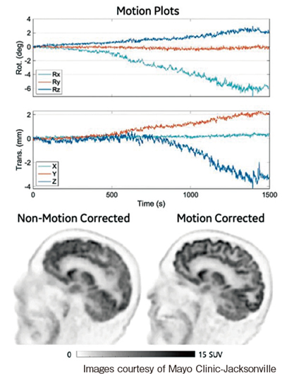 図1　MotionFree Brainによる動き補正 TOF Q.Clear（β100），ピクセルサイズ1.17mm×1.17mm×1.39mmで再構成。18F-FDG 386MBq投与，撮像時間は25分