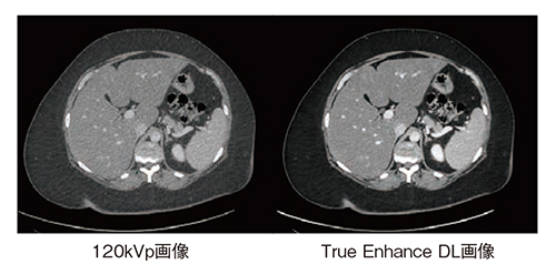 図4　症例(2)：高体重による造影剤量不足症例