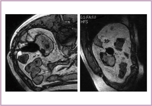 図9　症例2の再凍結治療中のMRI