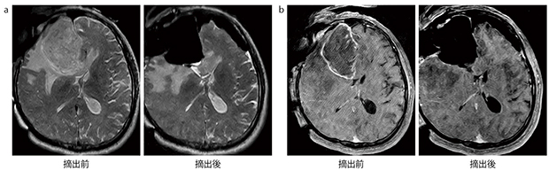 術中MRI