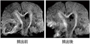 術中DWI