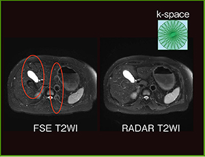 図1　RADAR（T2強調画像）