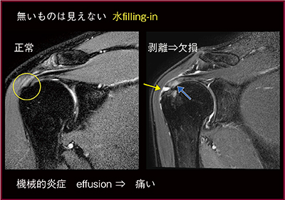 図5　腱板剥離：欠損部への水filling-inによる高信号