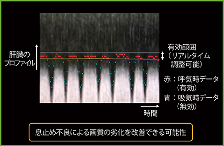 図6　横隔膜Navigatorを併用したNavi-TIGRE