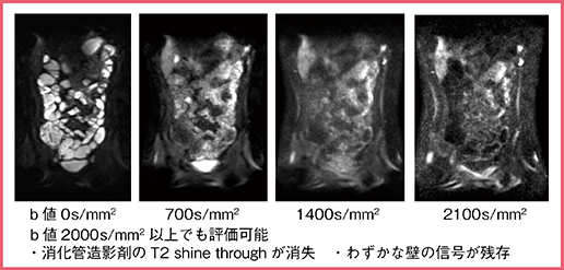 図4　高b値DWIの効果