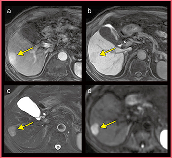 図4　原発性肝細胞がん症例（偽病変との鑑別） a：arterial phase　b：hepatobiliary phase c：T2強調画像　d：DWI（b=1000s/mm2）