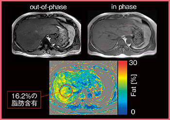 図6　fat fraction map（W.I.P.）