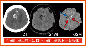 図1　出血と石灰化の鑑別：髄膜腫