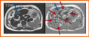 図6　腹部QSM：LC＋HCC