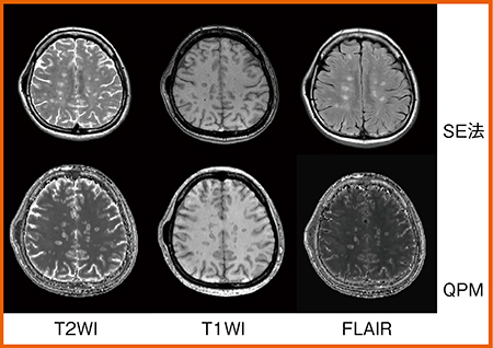図2　症例1：SE法とQPM定性画像