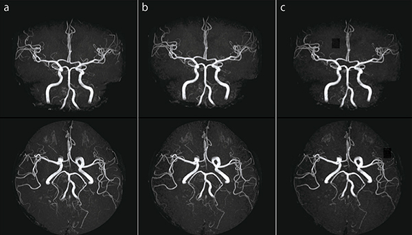 図5　頭部MRA　＊Freq/Phase＝周波数エンコード数/位相エンコード数 a：IP-RAPID off, Phase=2.0, Freq/Phase=256×256, scan time=4:48 b：IP-RAPID on, Phase=2.0, IP-Scan=1.3, Total=2.6, Freq/Phase=256×256, scan time=2:55 c：IP-RAPID on, Phase=2.0, IP-Scan=2.0, Total=4.0, Freq/Phase=256×256, scan time=1:55