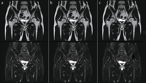 図6　股関節FatSep T2WI（上段：in Phase画像，下段：脂肪抑制画像） a：IP-RAPID off, Phase=1.1, Freq/Phase=256×256, scan time=2:49 b：IP-RAPID on, Phase=1.6, IP-Recon=Light, Freq/Phase=256×256, scan time=1:58 c：IP-RAPID on, Phase=2.5, IP-Recon=Medium, Freq/Phase=256×256, scan time=1:18