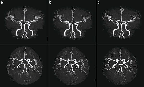 図9　頭部MRA a：IP-RAPID off, Phase=2.0, Freq/Phase=256×256, scan time=4:48 b：IP-RAPID on, Phase=1.6, IP-Scan=1.1, Total=1.7, Freq/Phase=288×288, scan time=4:48 c：IP-RAPID on, Phase=1.6, IP-Scan=1.2, Total=1.9, Freq/Phase=320×308, scan time=4:48