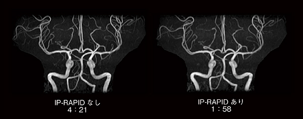 図4　MRA（MIP画像）におけるIP-RAPID有無の比較 撮像時間が半分以下においても，同等の画質が得られている。