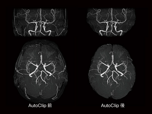 図7　AutoClip前後の比較（MIP画像） 不要な領域が削除されているのがわかる。
