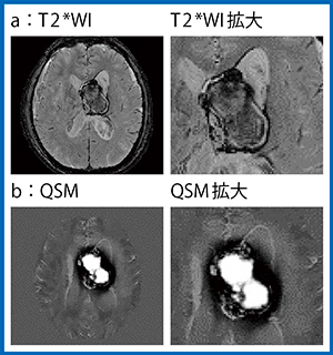 図2　症例1の磁化率画像