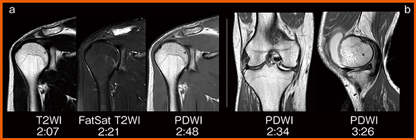図1　関節へのIP-RAPIDの適用 短時間撮像でも，FatSatによる脂肪抑制（a）やプロトン密度強調画像（b）で信号変化を明瞭にとらえている。