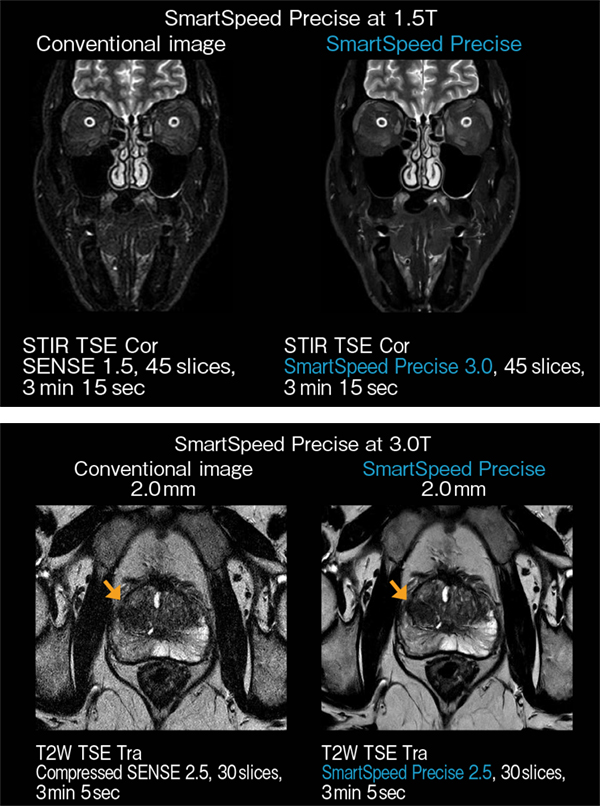 SmartSpeed Preciseの臨床画像 SmartSpeed Preciseの臨床画像