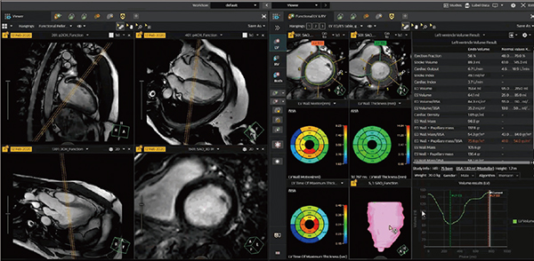 図1　AVW 15による心機能解析画面 刷新されたインターフェイスとAuto pre-processing機能により，精度を維持しながら効率化を促進。