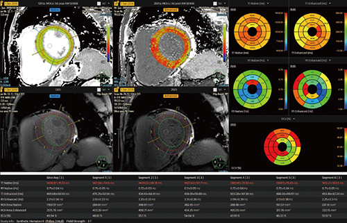 図2　AVW 15による心筋Mapping解析画面 セグメンテーションされたT1，T2，T2*map解析に加えて，当日採血データが不要なSynthetic ECV機能を搭載。