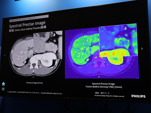 AI画像再構成「Spectral Precise Image」による膵がんの1mmスライススペクトラル画像