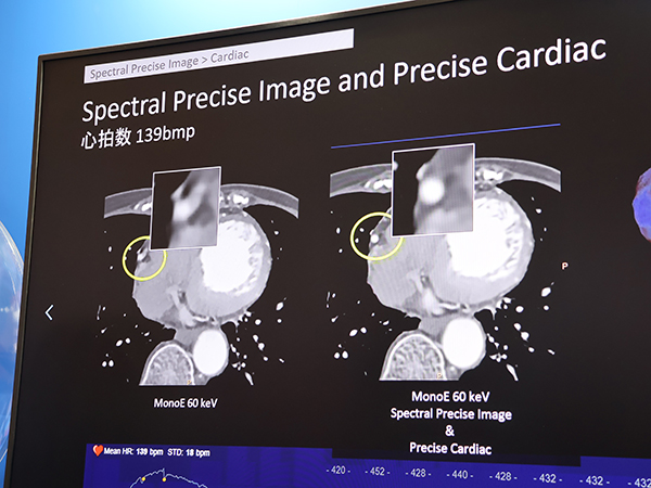 Spectral Precise Imageと「Precise Cardiac」の併用で高心拍症例の冠動脈の描出が向上