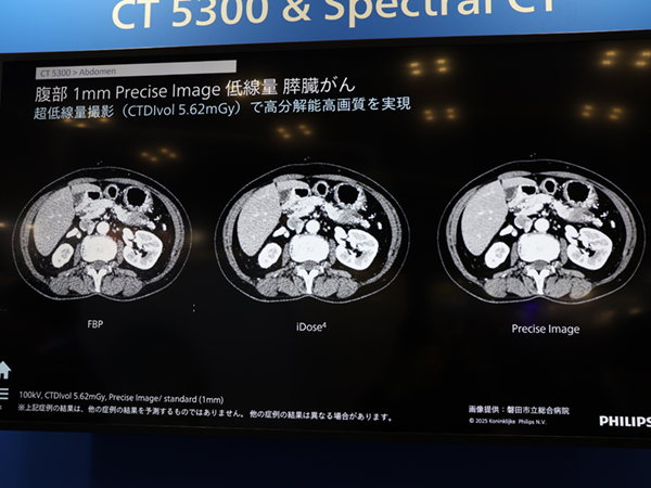 超低線量thin slice画像でもノイズを低減した高画質を得られる「Precise Image」