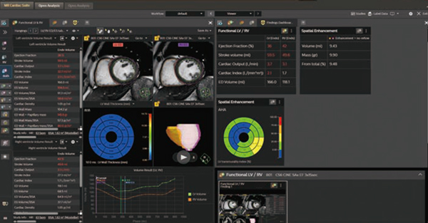 図1 MR Cardiac Suite上の2分割レイアウト 左:心機能解析 右:Finding dashboard画面 図1 MR Cardiac Suite上の2分割レイアウト 左:心機能解析 右:Finding dashboard画面