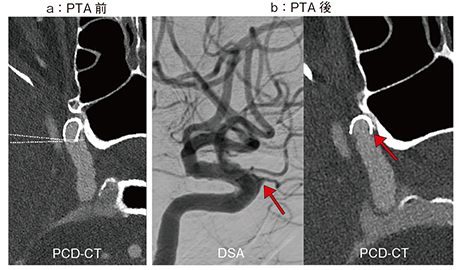 図3　症例2：ステントと血管壁への圧着の評価
