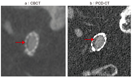 図4　症例3：ステントの内膜肥厚の評価