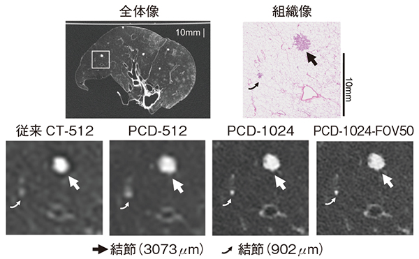 図1　従来CTとPCD-CTによる結節（腺癌の転移疑い）の描出能の比較（参考文献1）より引用転載）