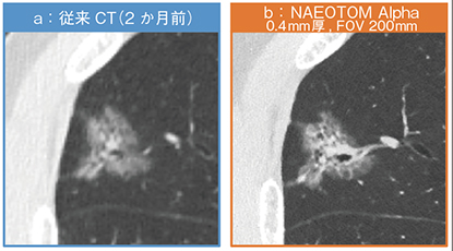 図3　症例1：肺がん（浸潤性腺癌）における気管支拡張像の評価
