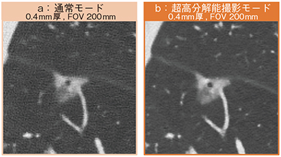 図4　症例2：肺がん症例における微細構造の描出