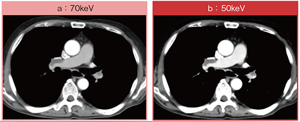 図7　症例5：肺動脈塞栓症疑い症例におけるSpectral Imagingによる造影効果の向上