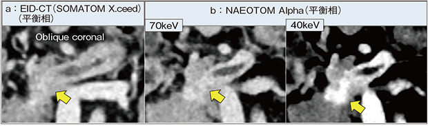 図2　NAEOTOM Alphaの低keV画像による平衡相での膵がんの描出