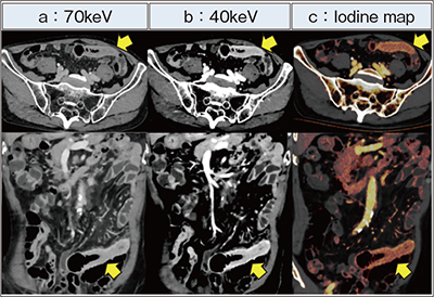 図4　NAEOTOM Alphaによるクローン病の活動性病変の評価