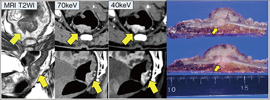 図5　NAEOTOM Alphaによる直腸がんの漿膜下浸潤の評
