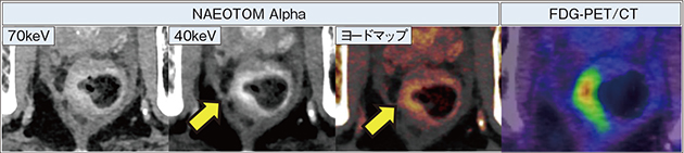 図6　NAEOTOM Alphaによる化学療法後の残存病変の検出