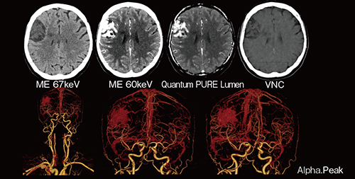 図1　髄膜腫症例におけるカルシウムの抑制と造影効果の増強