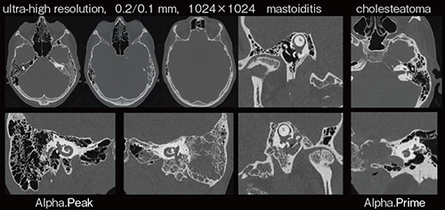 図2　超高解像度画像による側頭骨の描出