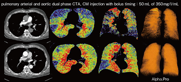 図4　高解像度画像による肺塞栓症症例の肺灌流の評価