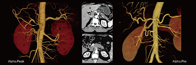 図6　高解像度画像による膵がんの血管解剖および腫瘍境界の描出