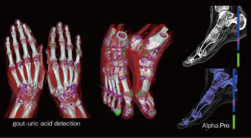図7　Spectral解析による痛風の尿酸沈着および痛風結節の描出