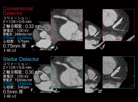 図3　冠動脈CTAにおけるConventional DetectorとStellar Detectorの比較