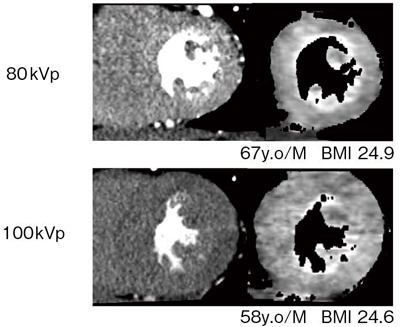 図7　Definition Flash（Conventional Detector）を用いた80kVと100kVの画像の比較