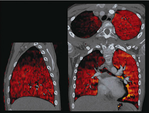 図1　Dual Energy Lung PBV