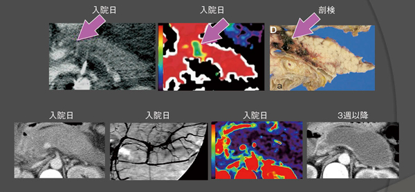 図3　上段：Perfusion CTと病理所見との比較1）下段：血管造影像とPerfusion CTとの比較2）