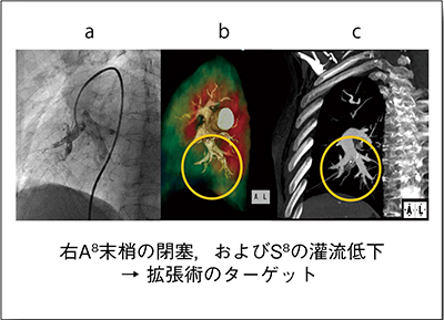 図4　症例3：CTEPH（70歳代，女性）のCTを用いた術前・術中ガイド